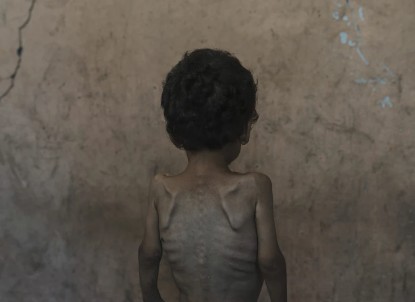 Hambruna Gaza